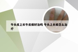 牛头皮上长牛皮癣好治吗 牛头上长癣怎么治疗