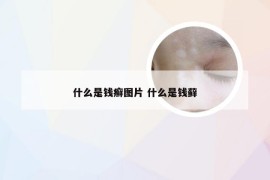 什么是钱癣图片 什么是钱藓