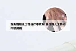 西瓜霜加凡士林治疗牛皮癣 西瓜霜凡士林治疗银屑病