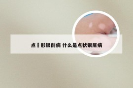 点湇形银削病 什么是点状银屑病