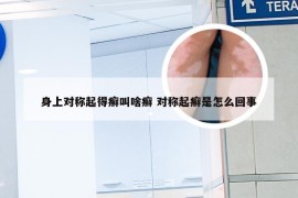 身上对称起得癣叫啥癣 对称起癣是怎么回事