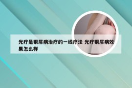 光疗是银屑病治疗的一线疗法 光疗银屑病效果怎么样