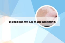 银屑病面部爆发怎么办 银屑病满脸都是咋办