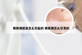 银屑病感染怎么引起的 银屑病怎么引发的