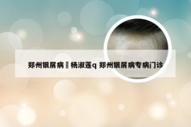 郑州银屑病問杨淑莲q 郑州银屑病专病门诊