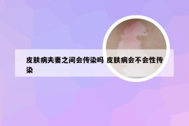 皮肤病夫妻之间会传染吗 皮肤病会不会性传染