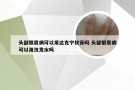 头部银屑病可以用达克宁软膏吗 头部银屑病可以用洗发水吗