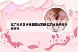 江门治银屑病哪里医院正规 江门皮肤病专科医医院