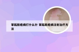 掌跖脓疱病打什么针 掌跖脓疱病注射治疗方法