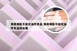 银屑病能不能吃油炸食品 银屑病能不能吃油炸食品和水果