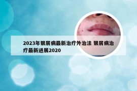 2023年银屑病最新治疗外治法 银屑病治疗最新进展2020