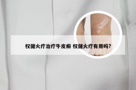 权健火疗治疗牛皮癣 权健火疗有用吗?