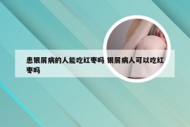 患银屑病的人能吃红枣吗 银屑病人可以吃红枣吗