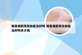 银屑病割耳放血能治好吗 银屑病割耳放血能治好吗多少钱