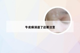 牛皮癣消退了还要注意