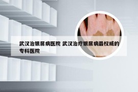 武汉治银屑病医院 武汉治疗银屑病最权威的专科医院