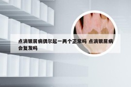 点滴银屑病偶尔起一两个正常吗 点滴银屑病会复发吗