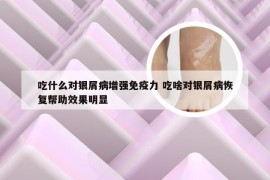 吃什么对银屑病增强免疫力 吃啥对银屑病恢复帮助效果明显