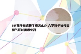 6岁孩子被遗传了癣怎么办 六岁孩子被传染脚气可以用哪些药