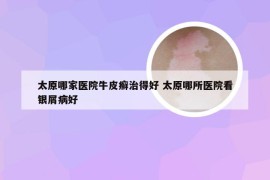 太原哪家医院牛皮癣治得好 太原哪所医院看银屑病好