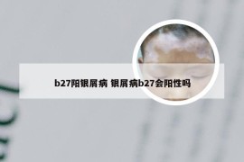 b27阳银屑病 银屑病b27会阳性吗