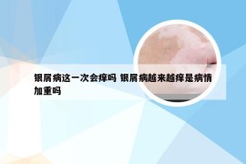 银屑病这一次会痒吗 银屑病越来越痒是病情加重吗