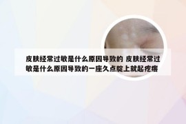 皮肤经常过敏是什么原因导致的 皮肤经常过敏是什么原因导致的一座久点腚上就起疙瘩