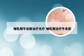 哺乳期牛皮廨治疗光疗 哺乳期治疗牛皮屑