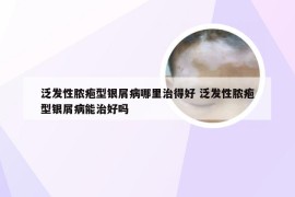 泛发性脓疱型银屑病哪里治得好 泛发性脓疱型银屑病能治好吗