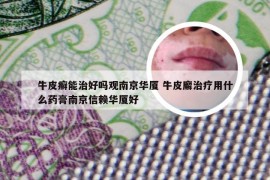 牛皮癣能治好吗观南京华厦 牛皮廨治疗用什么药膏南京信赖华厦好