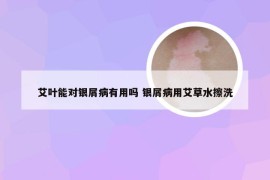 艾叶能对银屑病有用吗 银屑病用艾草水擦洗