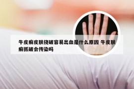 牛皮癣皮肤挠破容易出血是什么原因 牛皮肤癣抓破会传染吗