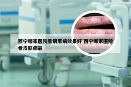 西宁哪家医院看银屑病效果好 西宁哪家医院看皮肤病最