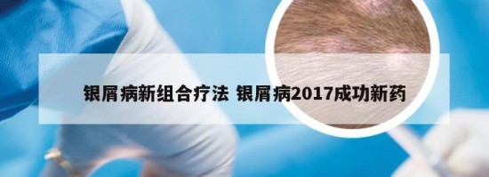 银屑病新组合疗法 银屑病2017成功新药