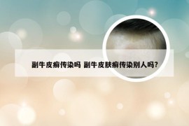 副牛皮癣传染吗 副牛皮肤癣传染别人吗?