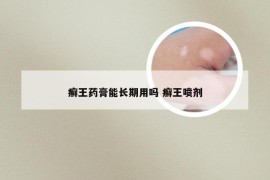 癣王药膏能长期用吗 癣王喷剂