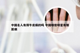 中国名人有得牛皮癣的吗 中国哪些明星有银屑病