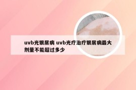 uvb光银屑病 uvb光疗治疗银屑病最大剂量不能超过多少