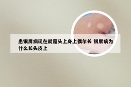 患银屑病现在就是头上身上偶尔长 银屑病为什么长头皮上