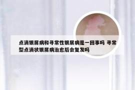 点滴银屑病和寻常性银屑病是一回事吗 寻常型点滴状银屑病治愈后会复发吗