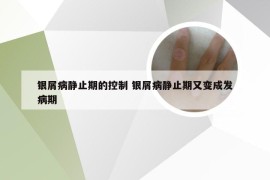 银屑病静止期的控制 银屑病静止期又变成发病期