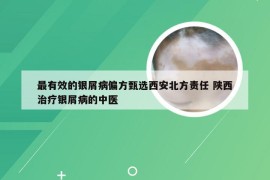 最有效的银屑病偏方甄选西安北方责任 陕西治疗银屑病的中医