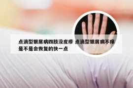 点滴型银屑病四肢没皮疹 点滴型银屑病不痒是不是会恢复的快一点