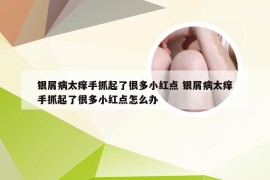 银屑病太痒手抓起了很多小红点 银屑病太痒手抓起了很多小红点怎么办