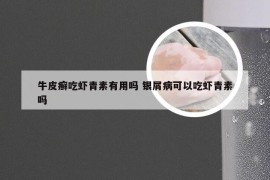 牛皮癣吃虾青素有用吗 银屑病可以吃虾青素吗