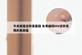 牛皮癣是逆转录基因 负责编码HIV逆转录酶的基因是