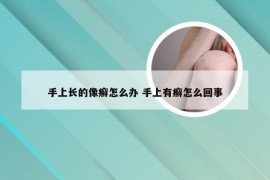 手上长的像癣怎么办 手上有癣怎么回事