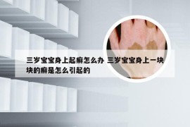 三岁宝宝身上起癣怎么办 三岁宝宝身上一块块的癣是怎么引起的