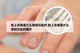 脸上皮癣是什么原因引起的 脸上皮癣是什么原因引起的图片