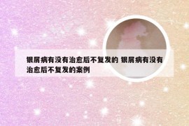 银屑病有没有治愈后不复发的 银屑病有没有治愈后不复发的案例